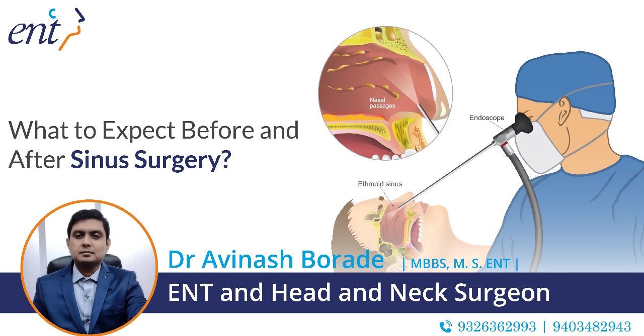 Before And After Sinus Surgery