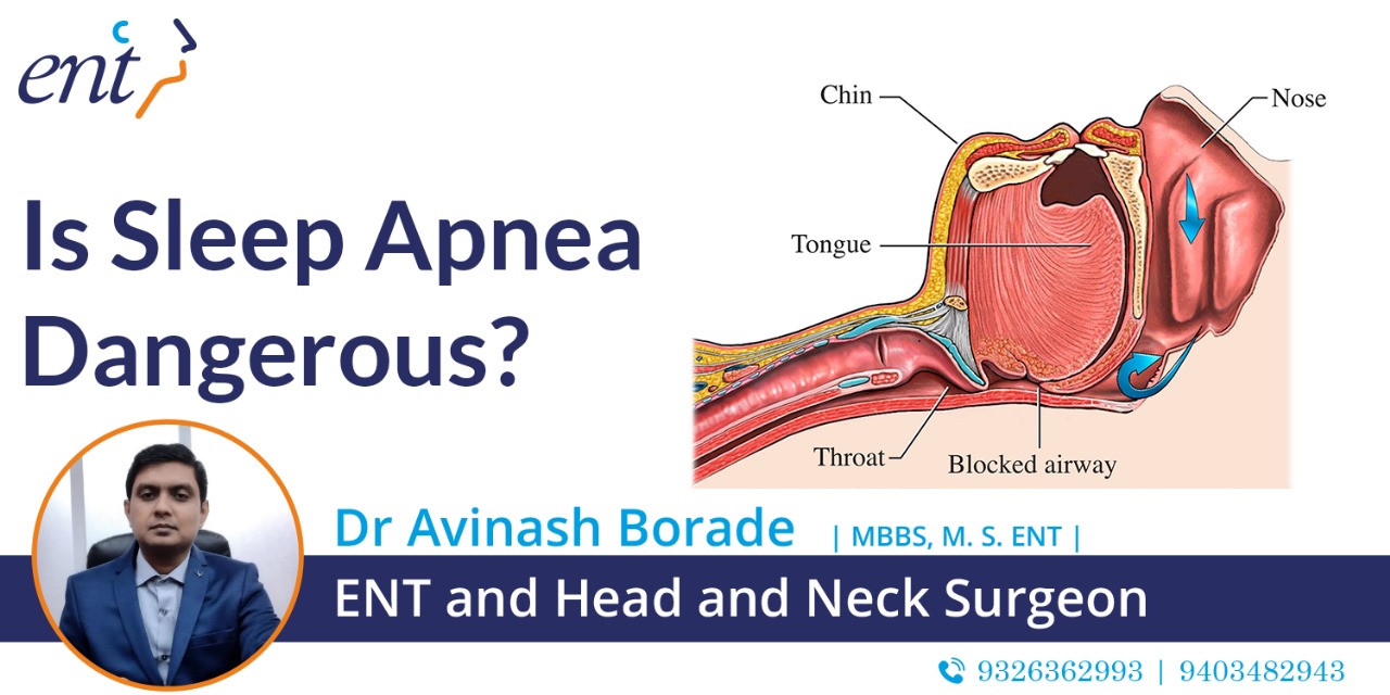 Is Sleep Apnea Dangerous? - Dr. Borade's ENT