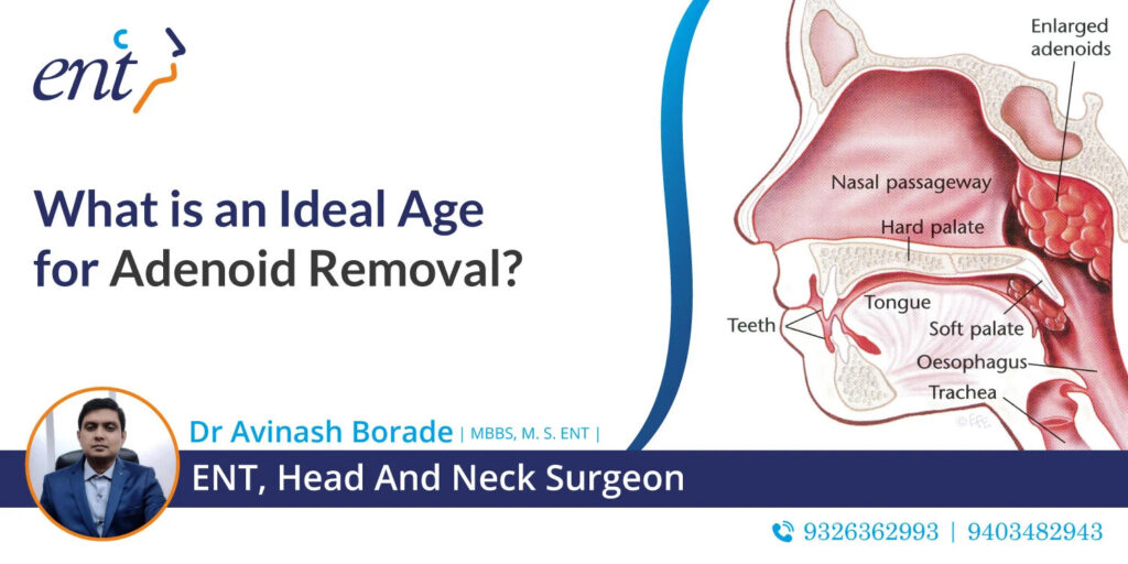 Adenoid Removal – Dr. Borades ENT Clinic