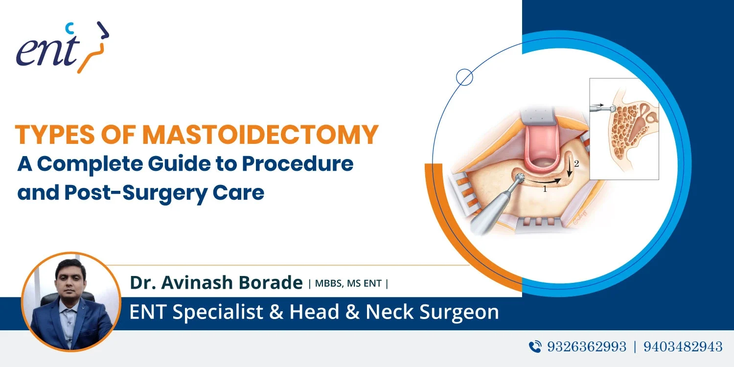 Types of Mastoidectomy: A Complete Guide to Procedure and Post-Surgery Care