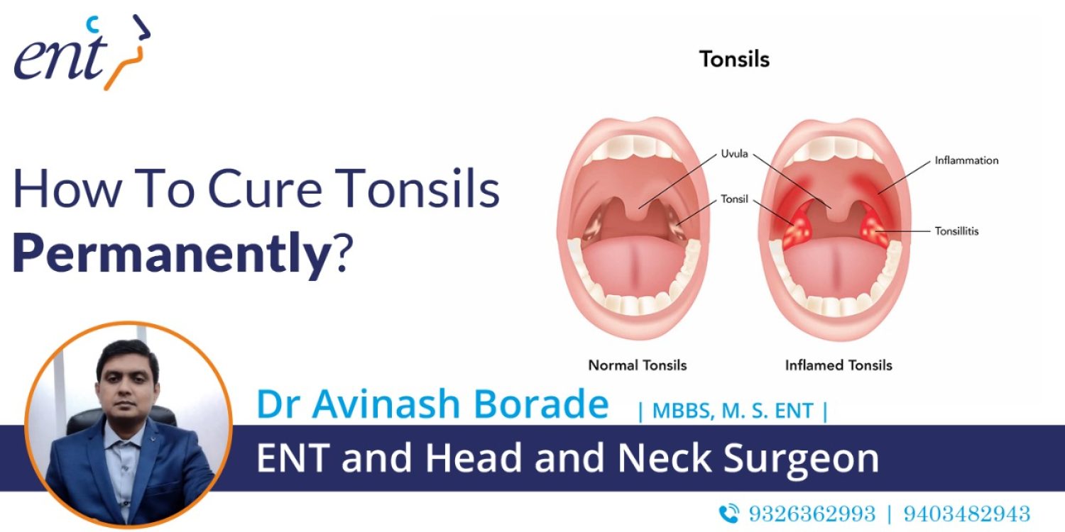 How To Cure Tonsils Permanently