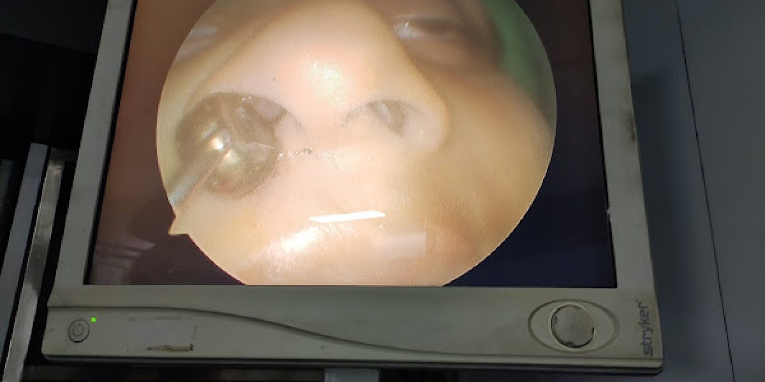 Removal of Foreign body in a 2.5yr old