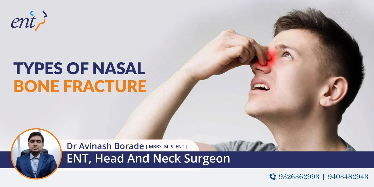 Types of Nasal Bone Fracture