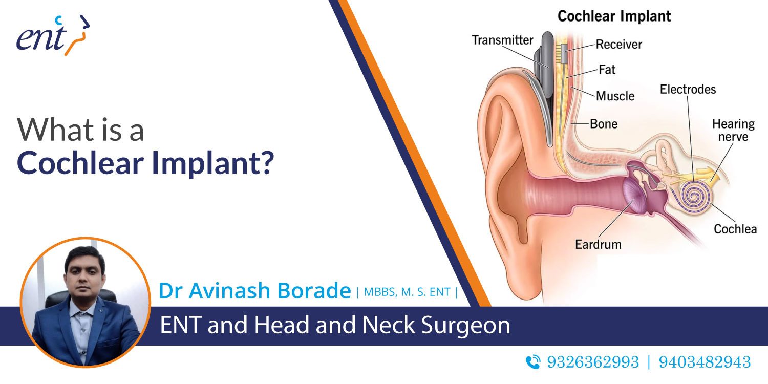 What is a Cochlear Implant