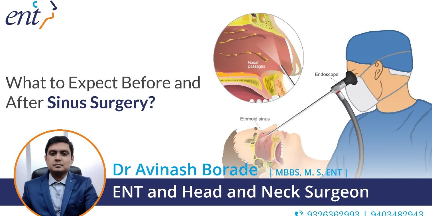 What to Expect Before and After Sinus Surgery